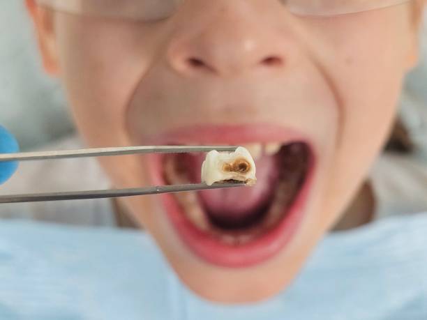 Best Emergency Tooth Extraction in Blissfield, MI